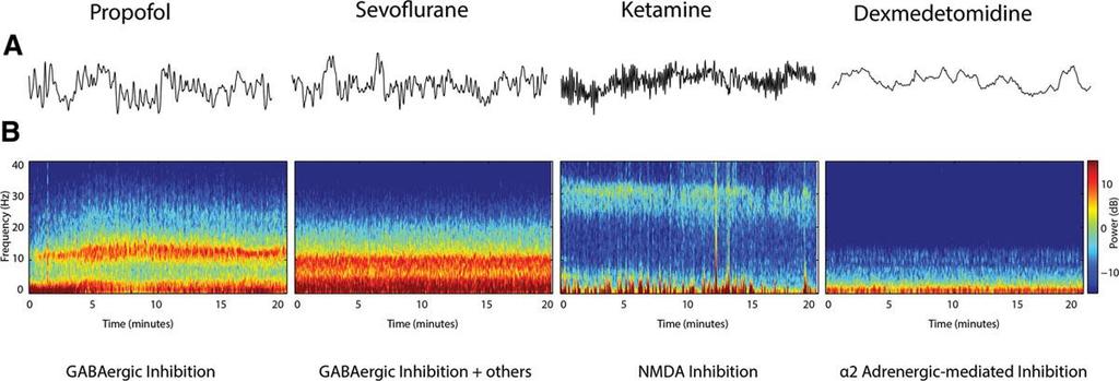 Každé anestetikum má specifické spektrum účinků. počítačem zpracované EEG (peeg), např. SEDLine: GABA-mimetika NMDA-antag.