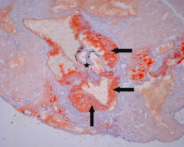 Histologické barvení olejovou červení Barvení olejovou červení bylo provedeno za účelem kvantifikace velikosti aterosklerotických plátů u myší krmených standardní dietou a u myší, které měly k dietě