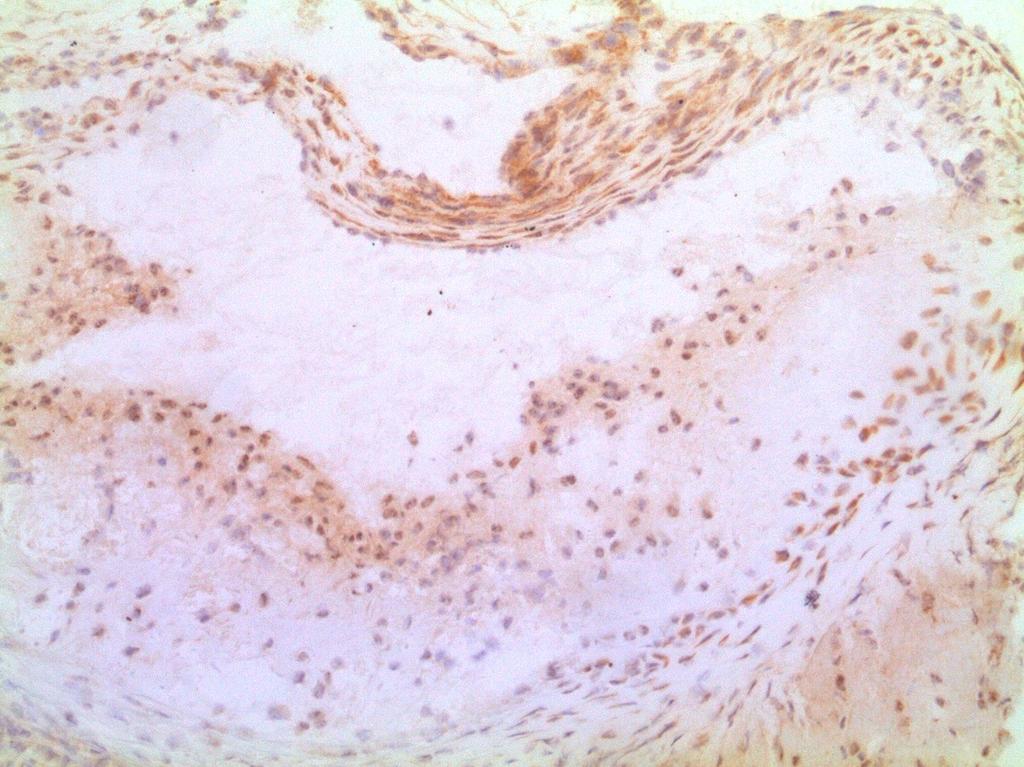 Imunohistochemická analýza Imunohistochemické barvení p-smad2 v oblasti aortálního sinu Exprese p-smad2 byla pozorována v aterosklerotických plátech obou skupin zvířat.