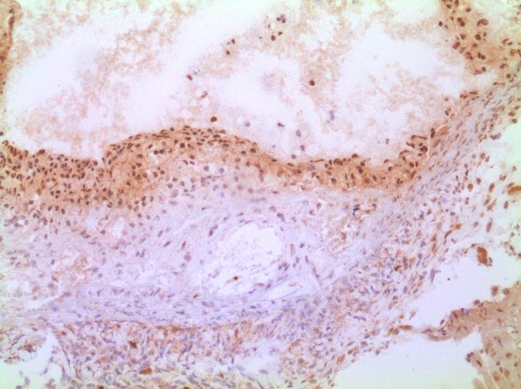 Obr.12: Reprezentativní obrázek imunohistochemického barvení p-smad2 u atorvastatinové skupiny.