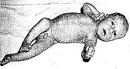 Obr. 6 Asymetrické držení těla novorozence - od 0 do 6 týdnů (Vojta, Peters, 1995) 3. 1. 2 Období 3.