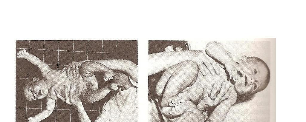 Obr. 11 a vlevo: Vojtova reakce, zdravé dítě 13 týdnů, Obr. 11 b vpravo: Vojtova reakce u zdravého kojence ve věku od 4. do 7.