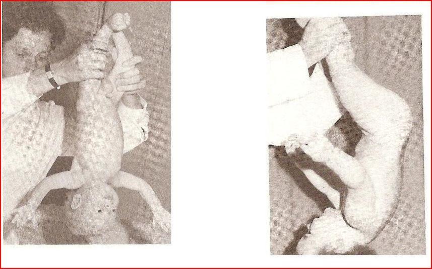 Obr. 12 a vlevo: Peiperova- Isbertova reakce u zdravého dítěte ve věku 4 týdnů, Obr. 12 b vpravo: táž reakce u zdravého kojence od 9.