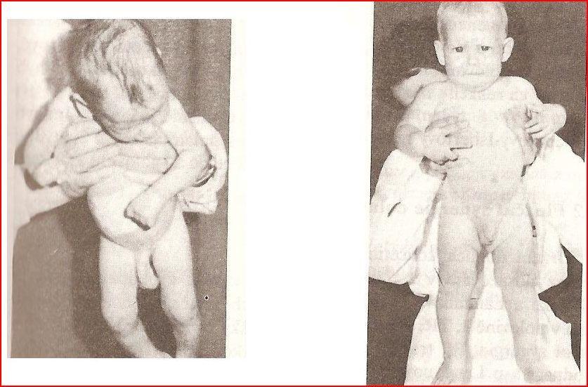 Obr. 13 a vlevo: axilární závěs u zdravého kojence do konce 3. měsíce Obr.