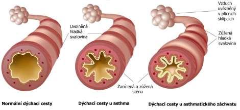 Obrázek 1: Srovnání průsvitu dýchacích cest u zdravého pacienta a asthmatika Zdroj: http://www.ci.independence.mo.us/health/mch-asthma, cit. 1. 4.