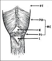 Parafaryngeální Zenkerův divertikl: Anatomicky dochází ke vzniku výchlipky mezi pars thyreopharyngea a cricophyrangea m.constrictor pharyngis inf. - v oblasti oslabené svalové vrstvy tzv.