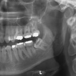2.1.1. Klasifikace retence dolních zubů moudrosti 1) Modifikovaná Winterova klasifikace (1926) - Tato klasifikace využívá popis angulace (sklonu) dlouhé osy retinovaného
