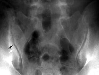 Tab. 5. Doporučení pro odeslání pacienta s podezřením na axiální spondyloartritidu (SpA) k revmatologovi Chronická bolest zad trvající déle než tři měsíce První příznaky před 45.