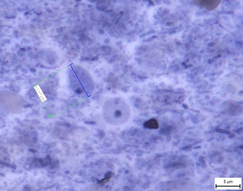 Obrázek 2: cysty Chilomastix mesnili VZORK 1 : cysty ndolimax nana četnost, cysty ntamoeba hartmanni četnost A cysty ntamoeba histolytica/dispar četnost A cysty ntamoeba coli četnost barveno