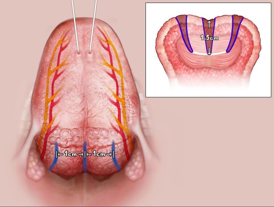 Resekce kořene jazyka Coblation endoscopic
