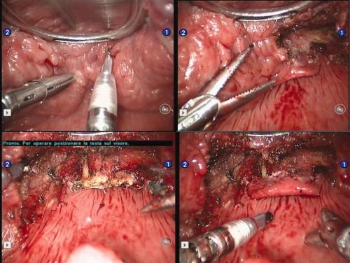 Transoral robotic tongue base