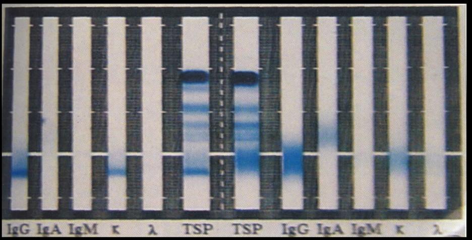 Výsledek: TSP levé patologické, vpravo normální nález Levá ELFO patologická v paraproteinu IgG, řetězec kappa Vpravo ELFO normální Vzniká neobvyklý pruh při klasické elfo séra, neboť paraprotein se
