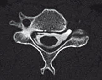 AVULZE MÍŠNÍCH KOŘENŮ: C6 C7 Těžká periferní paréza (téměř plegie) plexus brachialis l. dx. dolního i horního typu MR mozku + C páteře avulze C6 - C7 míšních kořenů?