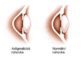 VADY OKA - astigmatismus čočka je v různých směrech různě zakřivená, oko nevidí