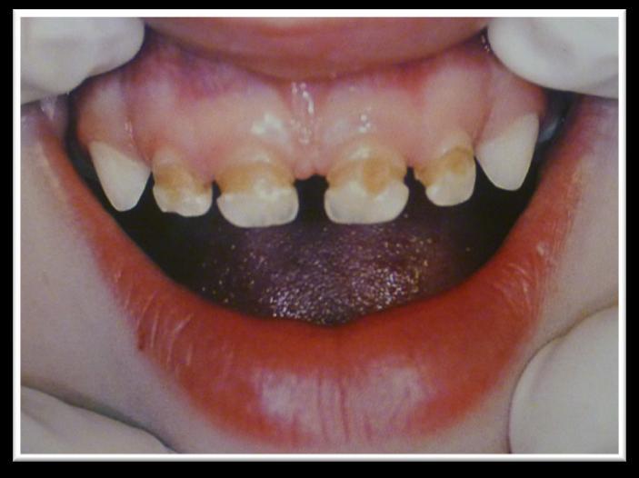 Typ III - rozsáhlé kariézní defekty postihující téměř všechny zuby včetně dolních řezáků (2, 5, 10) Obrázek 1 Kariézní postižení horních dočasných frontálních zubů (Merglová, Ivančaková 2009) 2.