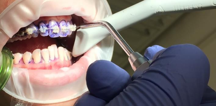 Následně si pacient sám odstraní plak správnou technikou čištění za pomoci zubního kartáčku, mezizubního kartáčku, který zavádí do mezizubních prostor a pod drát, solo kartáčkem, případně