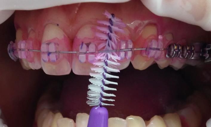 krok: Airflow, perioflow Pískování zubů a fixního ortodontického aparátu se