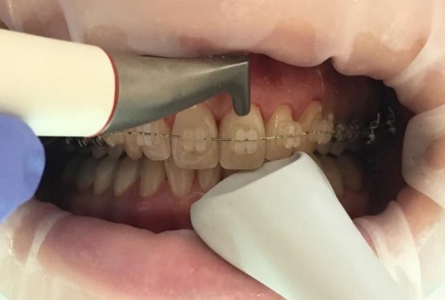 Obrázek 11 Optimální nastavení koncovky supragingiválně Obrázek 12 Optimální nastavení koncovky subgingiválně Výhoda airflow v porovnání s depurací pastou: Zubní kaz