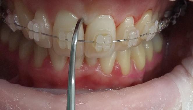 Obrázek 15 Přiložení nástroje na aproximální plochu zubu Graceyho kyreta Jedná se o ruční nástroj, kterým odstraňujeme supragingivální a subgingivální zubní kámen.