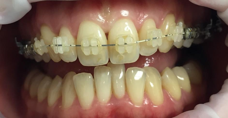 Fluoridace Na závěr na zuby naneseme preparáty s vysokým obsahem fluoridů, postupujeme podle návodu.
