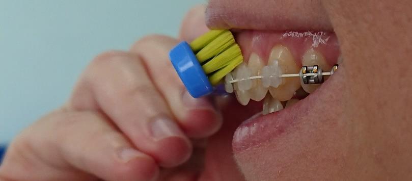Ruční zubní kartáček Ideální kartáček má malou hlavu, která je hustě osázená rovně střiženými a zaoblenými vlákny. Vlákna bývají nylonové nebo polyesterové. Zubní kartáček by měl být měkký.