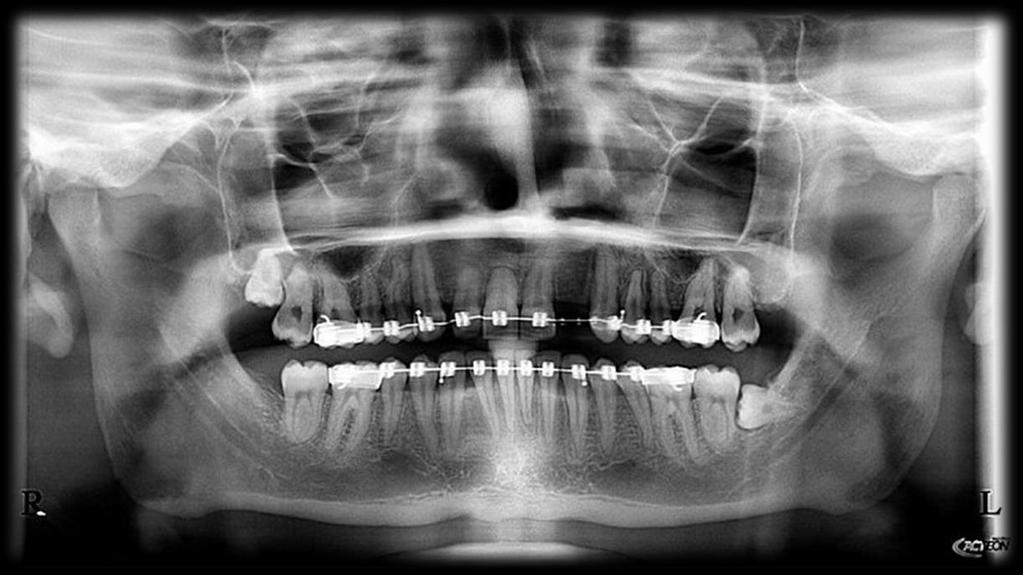 Obrázek 26 Ortopantomografický snímek 1. Vyšetření Pacient vypláchne ústní vodou s chlorhexidinem, následně na rty aplikujeme vazelínu.