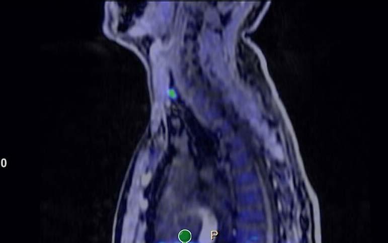 F-CH PET/MR Ložisko zvýšené akumulace za dolním pólem pravého laloku štítné žlázy, méně