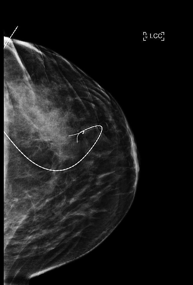 Obr. 35 - Scintigrafie sentinelové uzliny Zdroj WinMedicalc Obr.