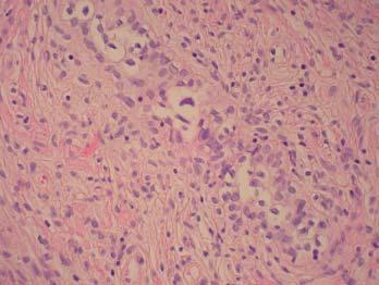 34 Obrázek 1. Karcinom prostaty vykazující postradiační změny. Nápadná vakuolizace cytoplazmy, patrná nápadná jadérka a zvětšená pyknotická jádra Obrázek 2.