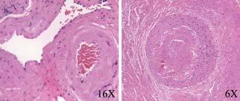 The Open Pathology Journal, 2009; 3: 64 73 myointimální proliferaci (obrázek 2), zúžení lumina či pěnové makrofágy. Hyalinizované a zúžené cévy jsou známkou toho, že pacient v minulosti prodělal RT.