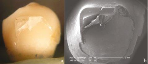 1: Stereromicroscope and SEM micrographs (35X) of representative failure modes for the ex-perimental groups tested.