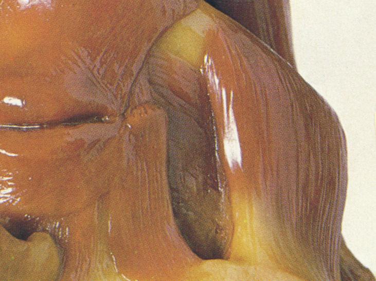 BI THERAPEUTICS Obr. 3: Musculus masseter Trigger Points (TPs). TPs žvýkacího Milani L., svalu 2019 FIG.
