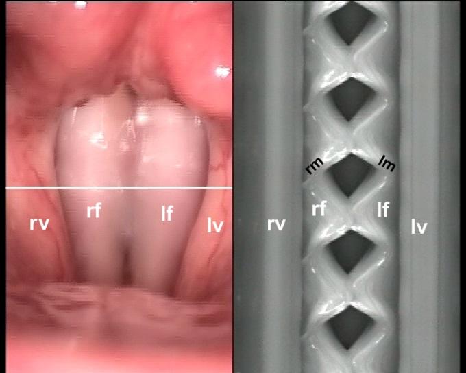 Obr. 5. Standardní videolaryngoskopický (vlevo) a vysokorychlostní VKG (vpravo) snímek hlasivek. Tyto video snímky jsou současně poskytovány VKG kamerou druhé generace.