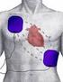 Elektrická kardioverze a defibrilace