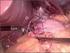 Refluxní nemoc jícnu v pohledu laparoskopické chirurgie