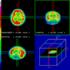 Tau protein a beta amyloid v likvoru u Alzheimerovy choroby