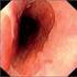 Recidivující laryngitidy a refluxní choroba jícnu
