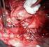 Chirurgické řešení píštěle mezi aneuryzmatem věnčité tepny a pravou síní
