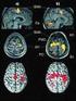 Detekce korové aktivity vyvolané míšním neurostimulátorem u pacientů trpících nezvladatelnou neuropatickou bolestí