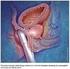 DOES PROSTATE RE-BIOPSY HAVE TO INCLUDE A BIOPSY OF THE TRANSITIONAL ZONE?