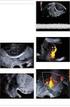 Možnosti ultrazvukové predikce placenta accreta v klinické praxi