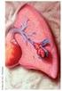 Plicní embolizace (PE)