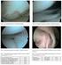 Operační řešení avulzního poranění tibiálního úponu zadního zkříženého vazu