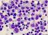 Prognostický význam transkripce genu pro angiopoietin-2 u chronické lymfocytární leukémie