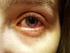 TOBRADEX oční kapky, suspenze (tobramycinum / dexamethasonum)