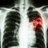 Výskyt tuberkulózy v ČR v roce 2001